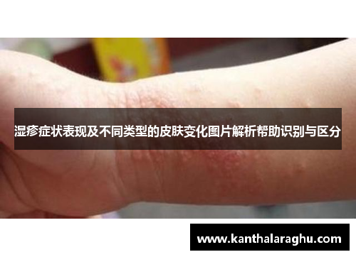 湿疹症状表现及不同类型的皮肤变化图片解析帮助识别与区分 湿疹症状表现及不同类型的皮肤变化图片解析帮助识别与区分